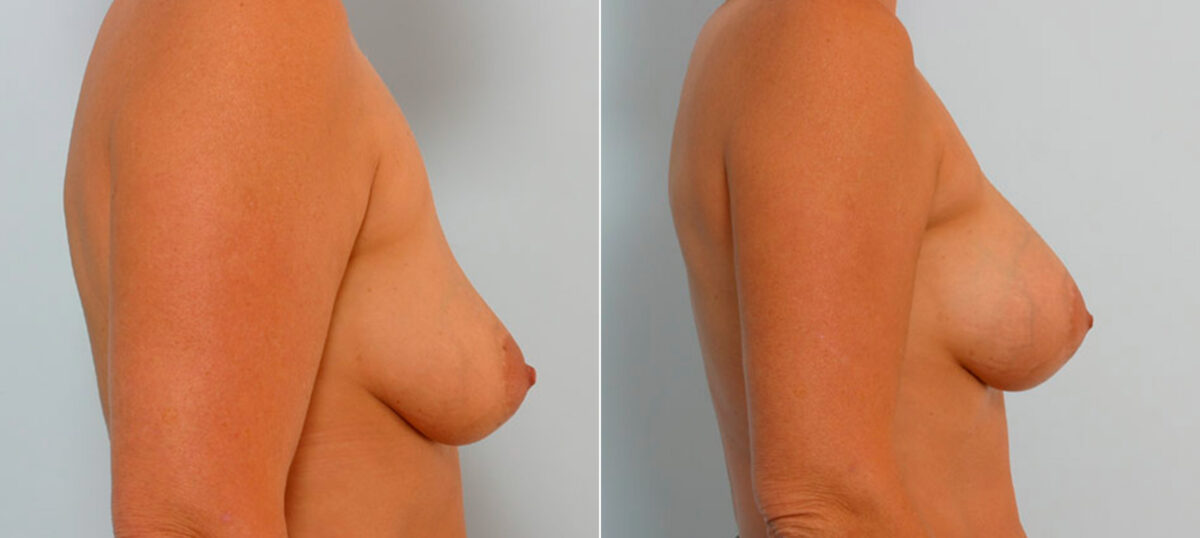 Breast Augmentation before and after photos in Houston, TX, Patient 25481