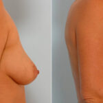 Breast Augmentation before and after photos in Houston, TX, Patient 25481