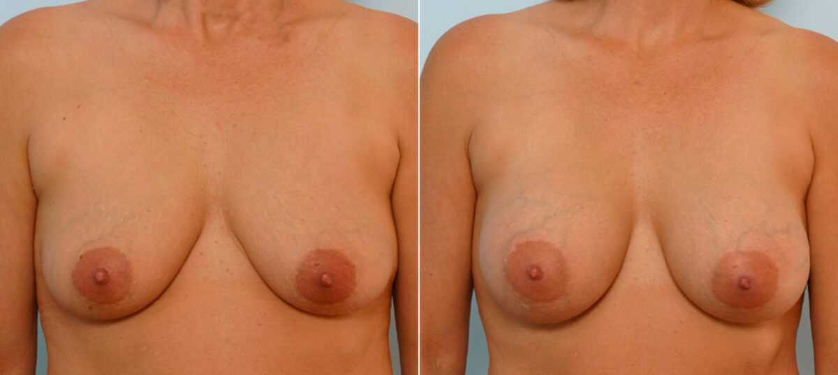 Breast Augmentation before and after photos in Houston, TX, Patient 25481