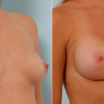 Breast Augmentation before and after photos in Houston, TX, Patient 25488