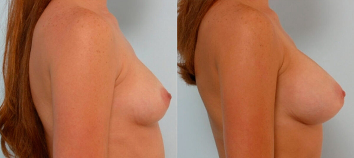 Breast Augmentation before and after photos in Houston, TX, Patient 25488