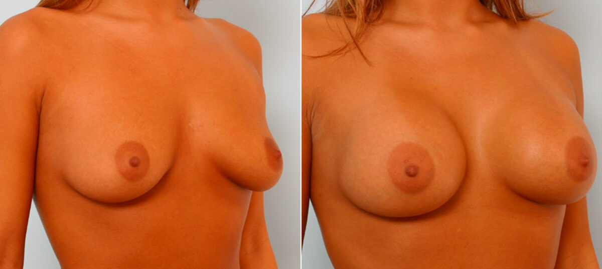 Breast Augmentation before and after photos in Houston, TX, Patient 25495