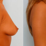 Breast Augmentation before and after photos in Houston, TX, Patient 25495