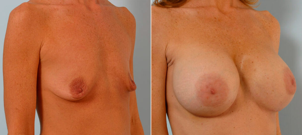 Breast Augmentation before and after photos in Houston, TX, Patient 25502