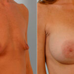 Breast Augmentation before and after photos in Houston, TX, Patient 25502