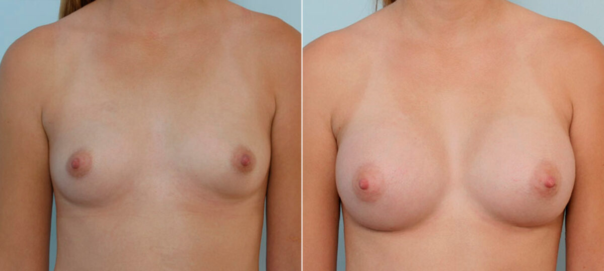 Breast Augmentation before and after photos in Houston, TX, Patient 25509