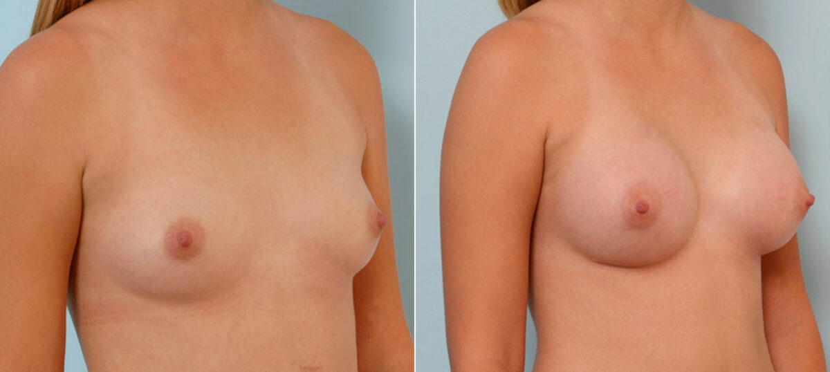 Breast Augmentation before and after photos in Houston, TX, Patient 25509