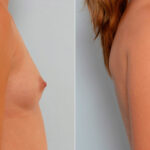 Breast Augmentation before and after photos in Houston, TX, Patient 25509