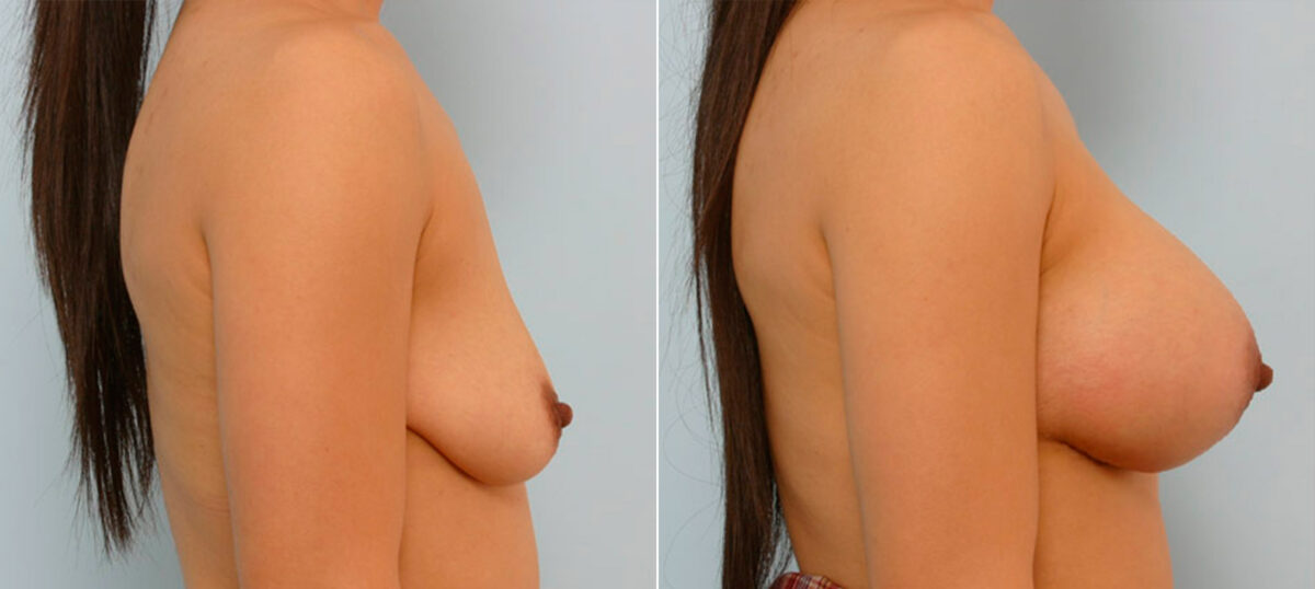 Breast Augmentation before and after photos in Houston, TX, Patient 25516