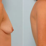 Breast Augmentation before and after photos in Houston, TX, Patient 25523