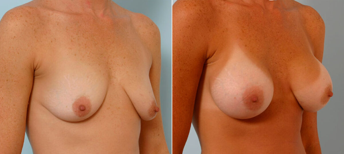 Breast Augmentation before and after photos in Houston, TX, Patient 25523