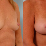 Breast Augmentation before and after photos in Houston, TX, Patient 25530