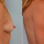 Breast Augmentation before and after photos in Houston, TX, Patient 25530