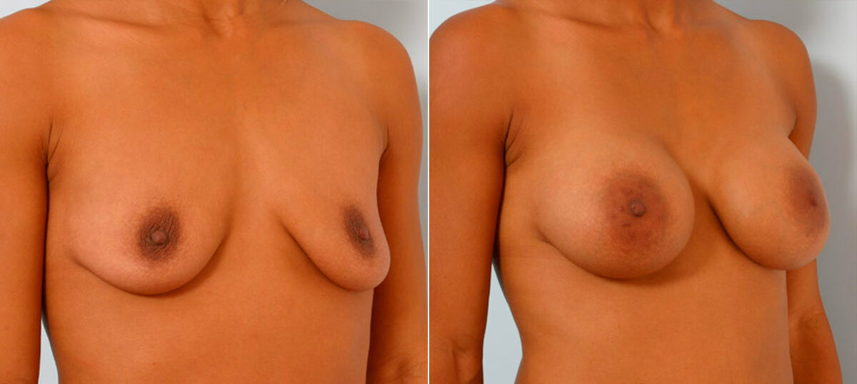 Breast Augmentation before and after photos in Houston, TX, Patient 25537