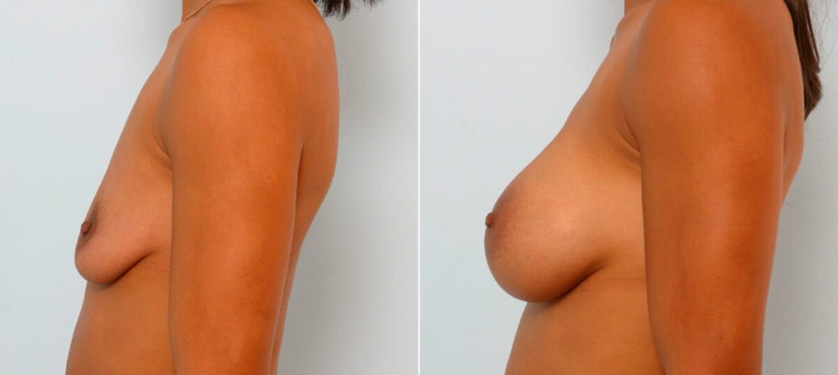 Breast Augmentation before and after photos in Houston, TX, Patient 25537