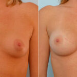 Breast Augmentation before and after photos in Houston, TX, Patient 25544