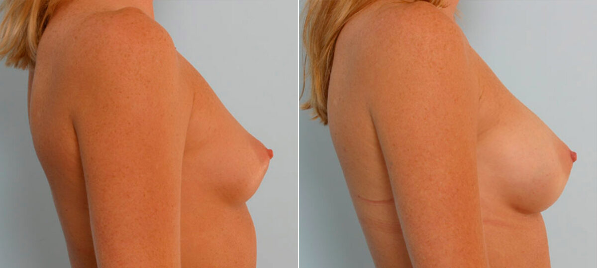Breast Augmentation before and after photos in Houston, TX, Patient 25544