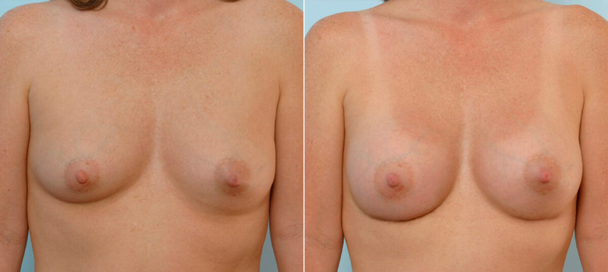 Breast Augmentation before and after photos in Houston, TX, Patient 25551