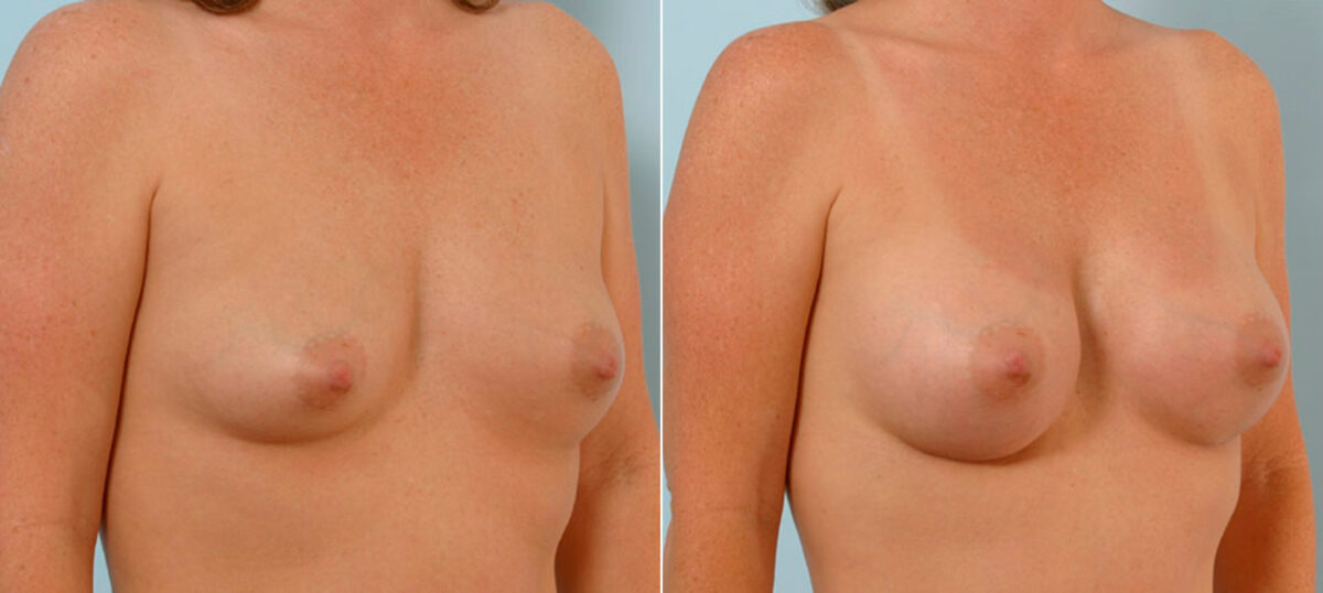 Breast Augmentation before and after photos in Houston, TX, Patient 25551