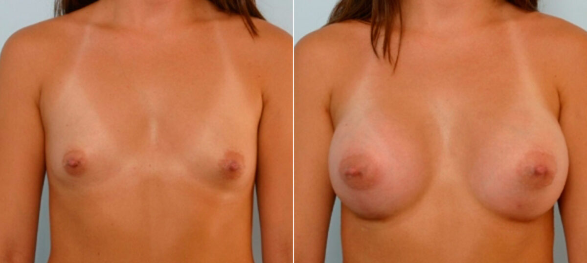 Breast Augmentation before and after photos in Houston, TX, Patient 25558