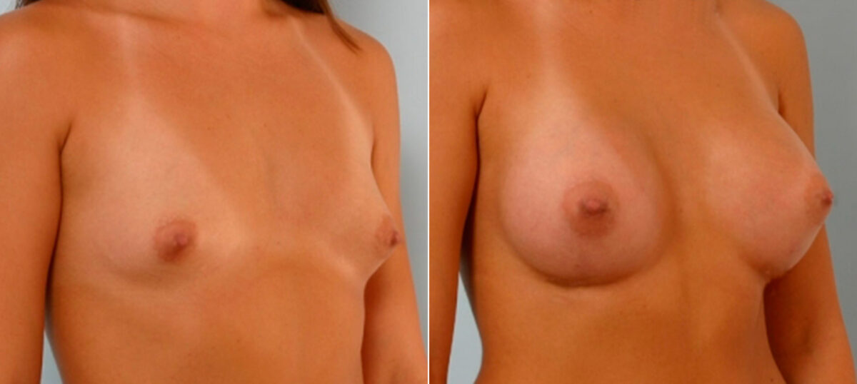 Breast Augmentation before and after photos in Houston, TX, Patient 25558