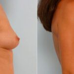 Breast Augmentation before and after photos in Houston, TX, Patient 25565