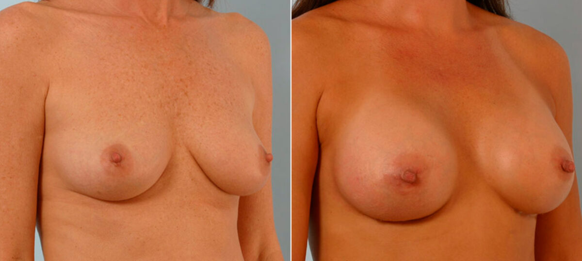 Breast Augmentation before and after photos in Houston, TX, Patient 25565