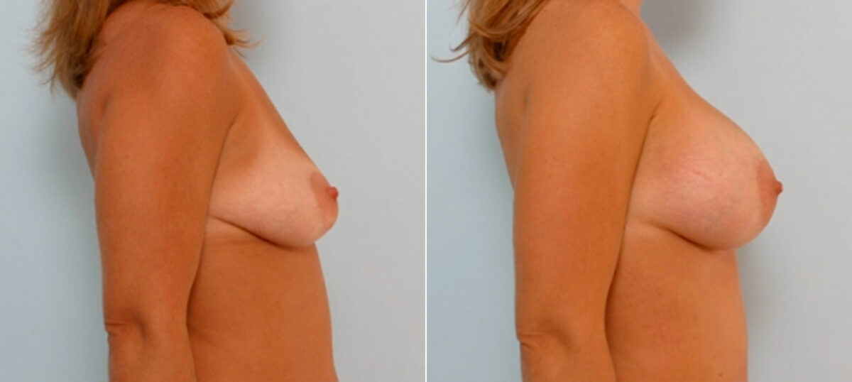 Breast Augmentation before and after photos in Houston, TX, Patient 25572