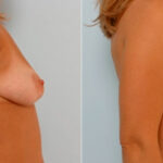 Breast Augmentation before and after photos in Houston, TX, Patient 25572