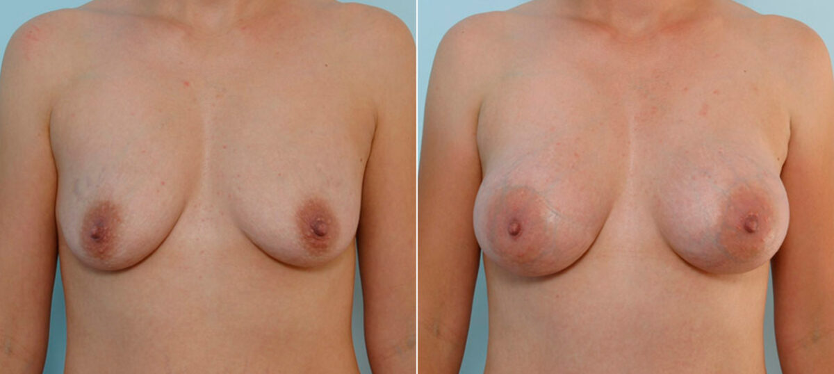 Breast Augmentation before and after photos in Houston, TX, Patient 25579