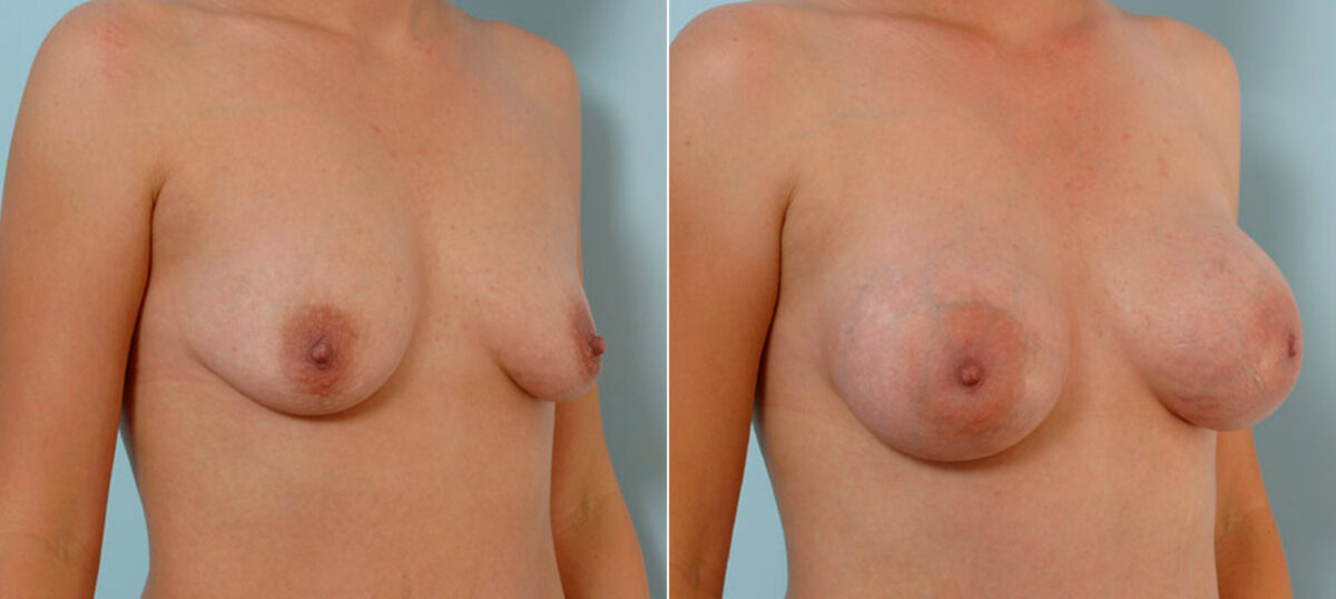Breast Augmentation before and after photos in Houston, TX, Patient 25579