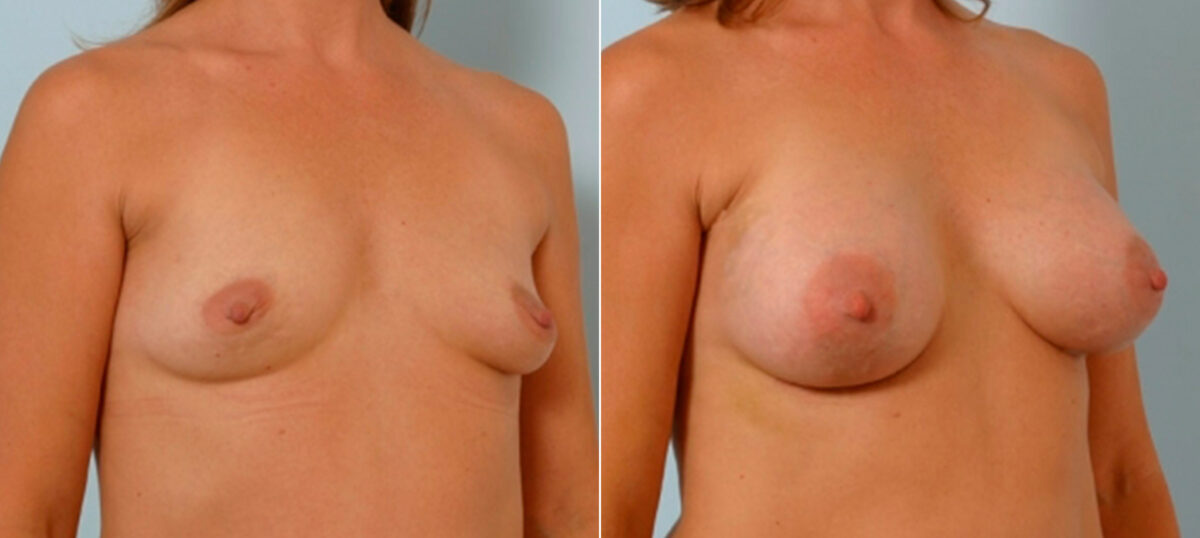 Breast Augmentation before and after photos in Houston, TX, Patient 25586