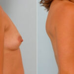 Breast Augmentation before and after photos in Houston, TX, Patient 25586