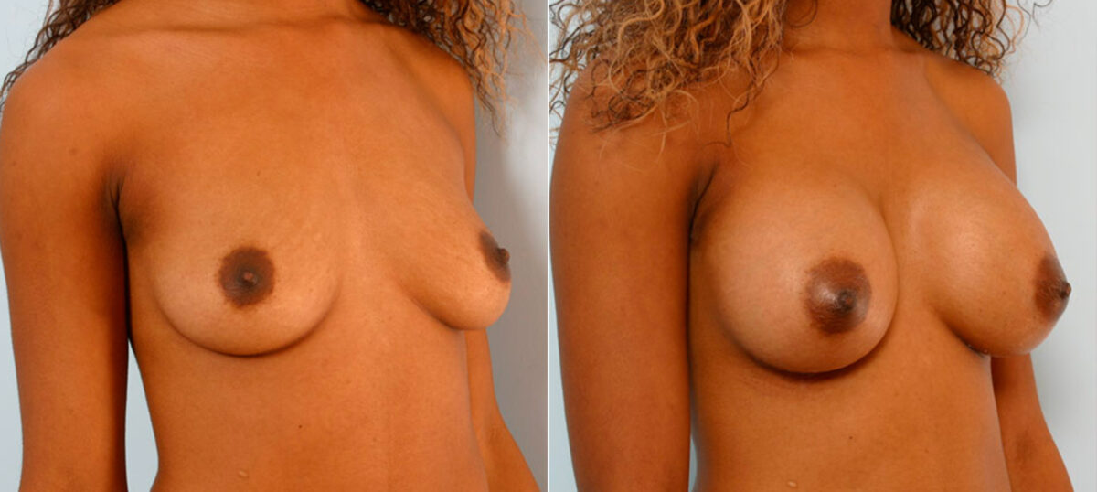Breast Augmentation before and after photos in Houston, TX, Patient 25593