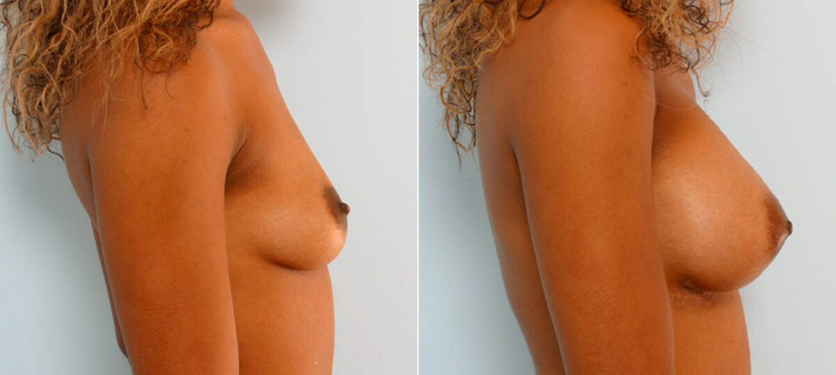 Breast Augmentation before and after photos in Houston, TX, Patient 25593