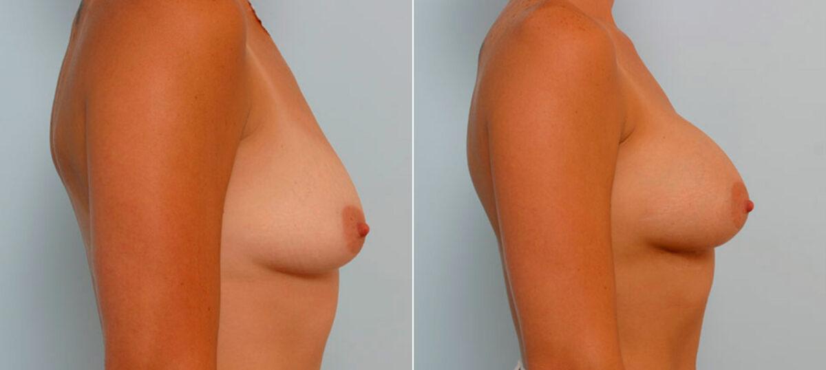 Breast Augmentation before and after photos in Houston, TX, Patient 25600