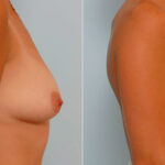 Breast Augmentation before and after photos in Houston, TX, Patient 25600