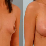 Breast Augmentation before and after photos in Houston, TX, Patient 25607