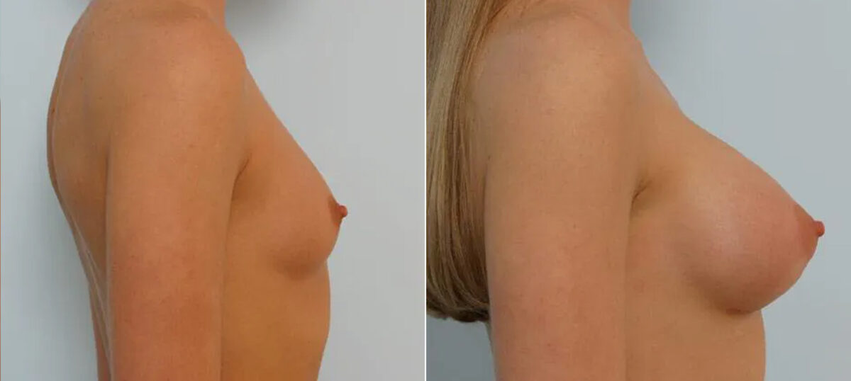 Breast Augmentation before and after photos in Houston, TX, Patient 25614