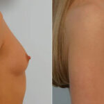 Breast Augmentation before and after photos in Houston, TX, Patient 25614