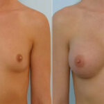 Breast Augmentation before and after photos in Houston, TX, Patient 25614