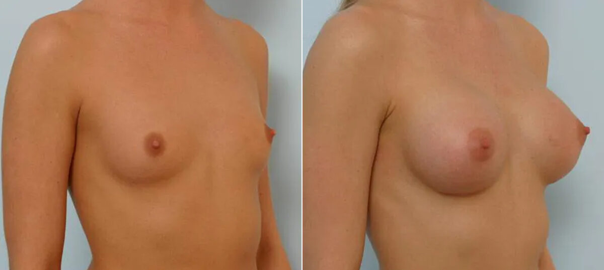 Breast Augmentation before and after photos in Houston, TX, Patient 25614