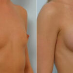 Breast Augmentation before and after photos in Houston, TX, Patient 25614