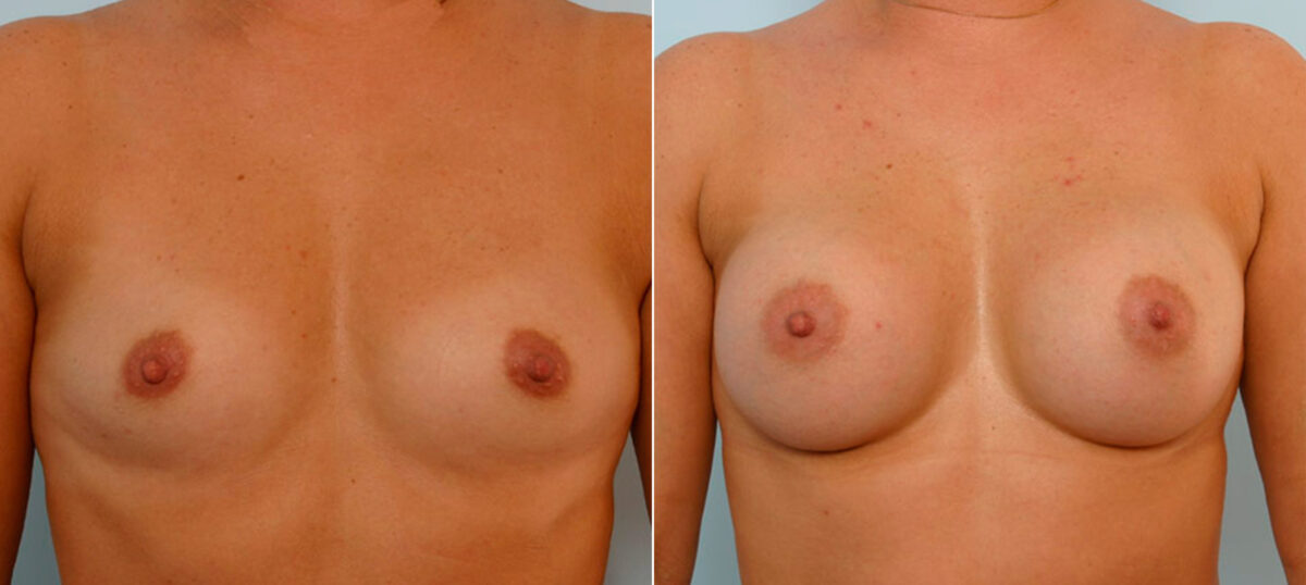 Breast Augmentation before and after photos in Houston, TX, Patient 25621