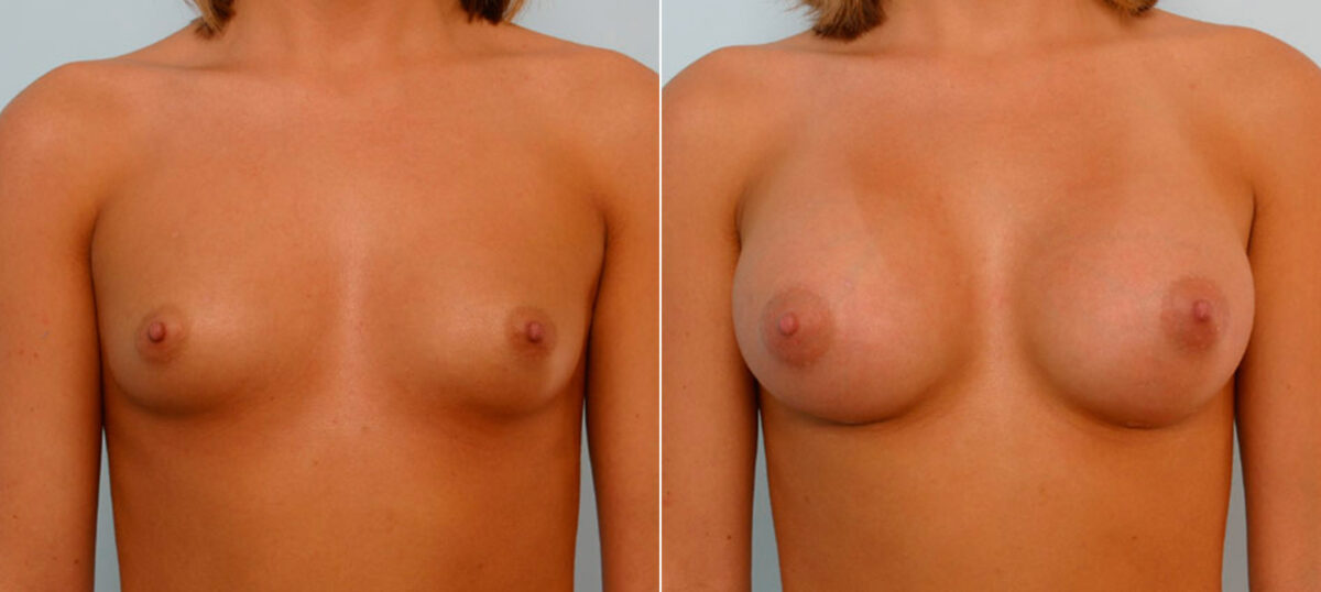 Breast Augmentation before and after photos in Houston, TX, Patient 25628