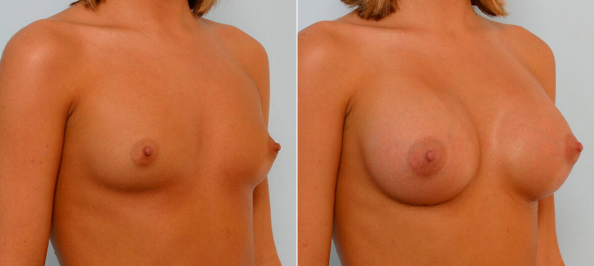 Breast Augmentation before and after photos in Houston, TX, Patient 25628