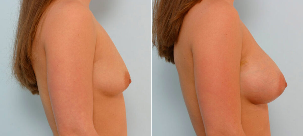 Breast Augmentation before and after photos in Houston, TX, Patient 25635