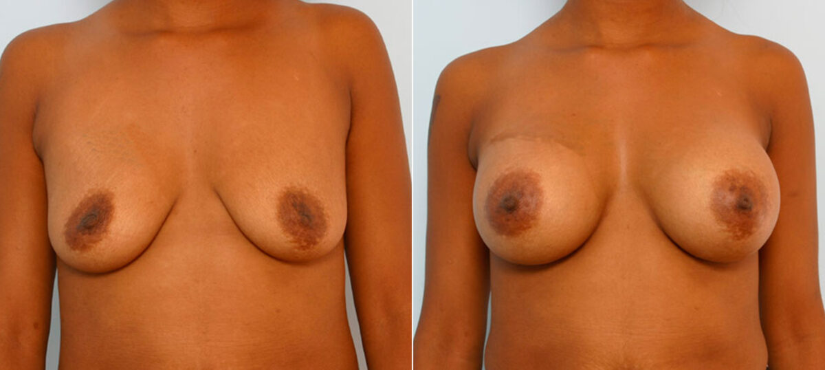 Breast Augmentation before and after photos in Houston, TX, Patient 25642