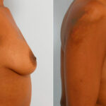 Breast Augmentation before and after photos in Houston, TX, Patient 25642