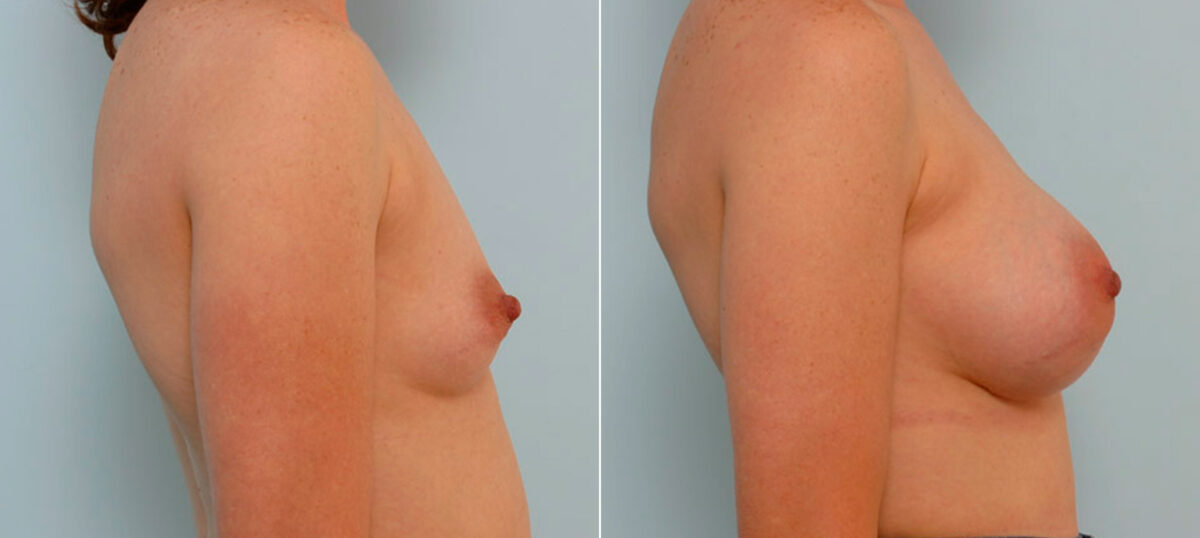 Breast Augmentation before and after photos in Houston, TX, Patient 25649